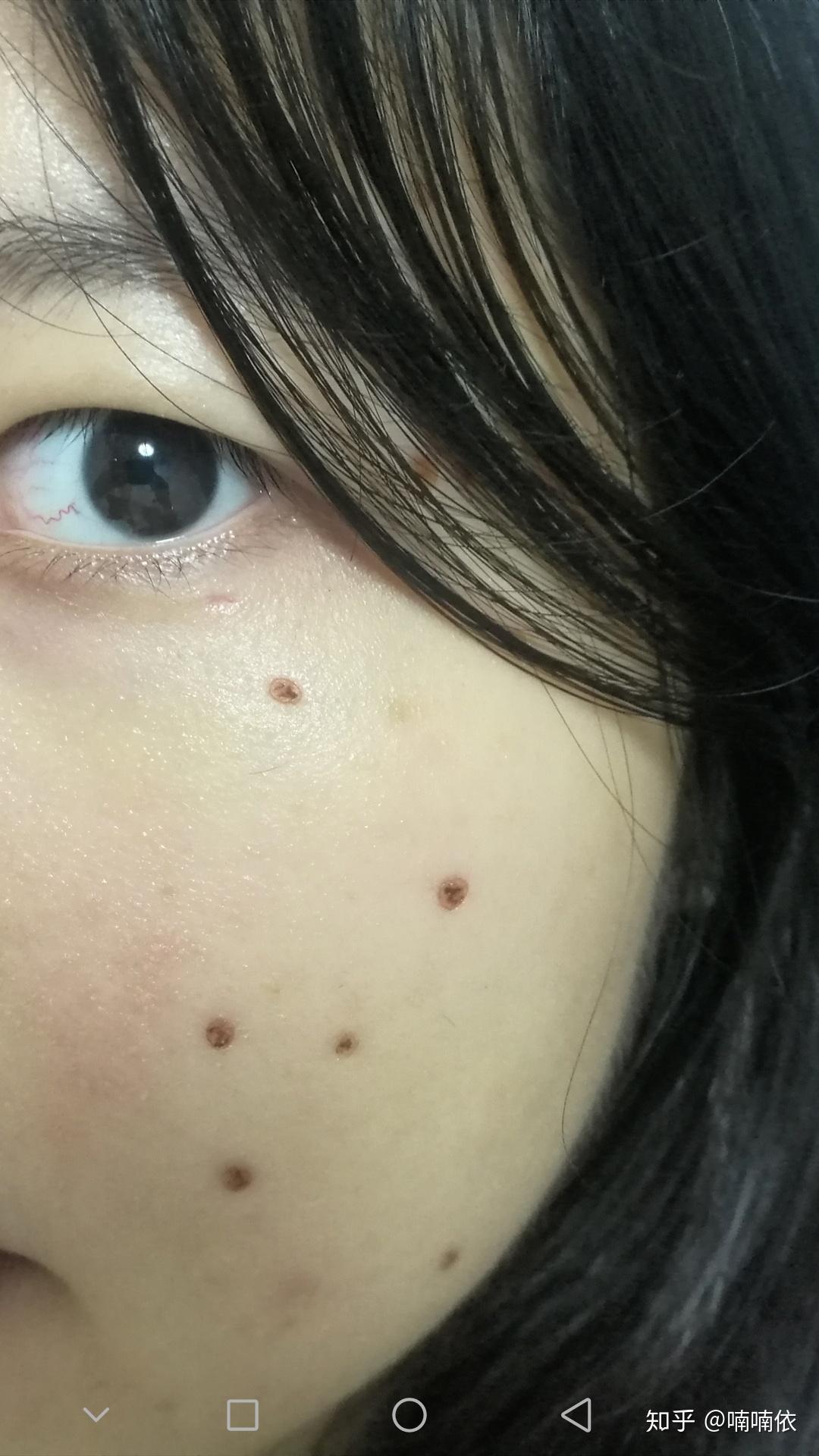 医院点痣价格解析