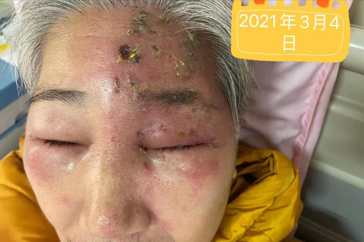 治疗带状疱疹的最佳药物
