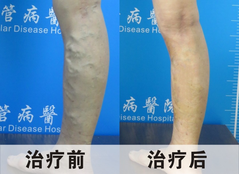 治疗静脉曲张，简单有效的方法，每天坚持恢复
