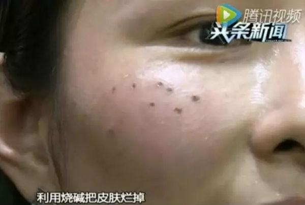 深圳医院点痣价格解析