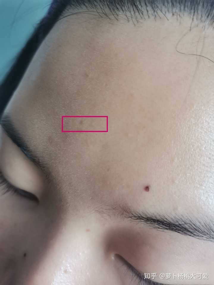 医院点痣价格解析，一颗痦子所需费用