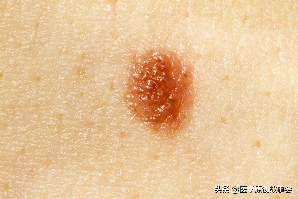 点痣去医院挂号科室及费用参考