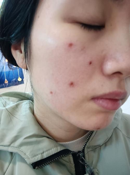 点痣去医院费用是多少