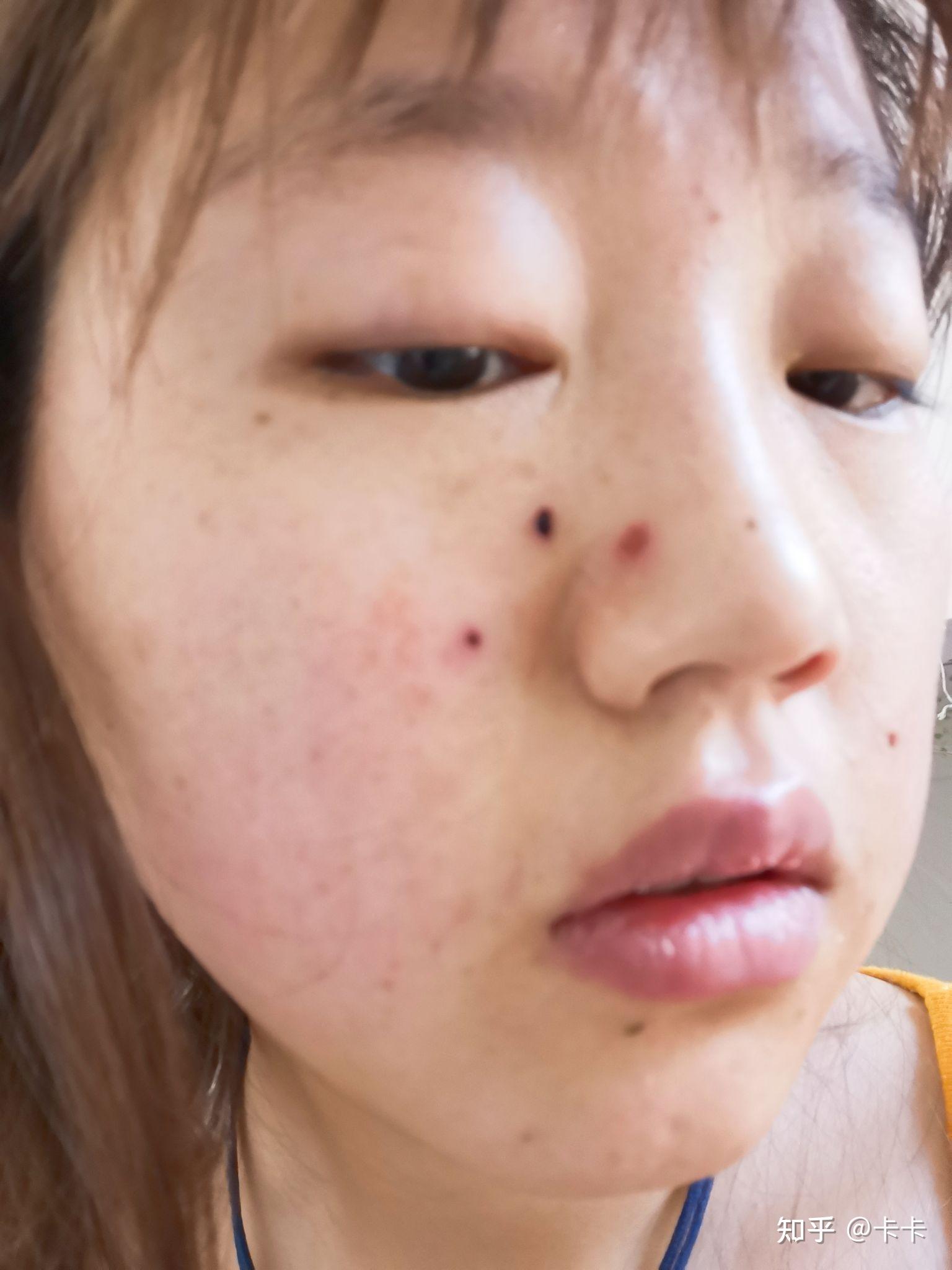 上海点痣多少钱一颗正规医院介绍
