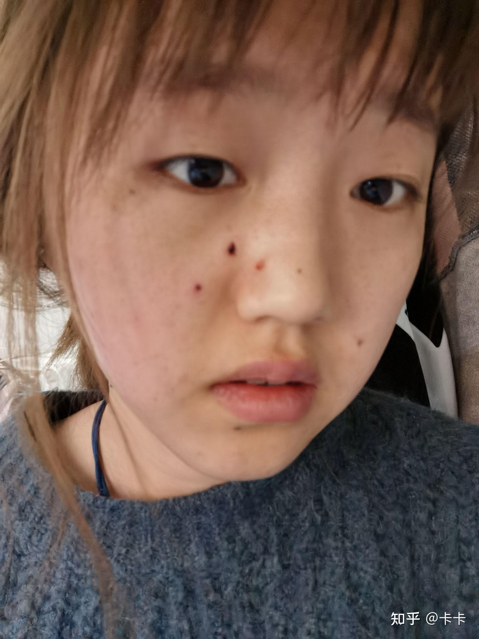 点痣医院一般多少钱一颗
