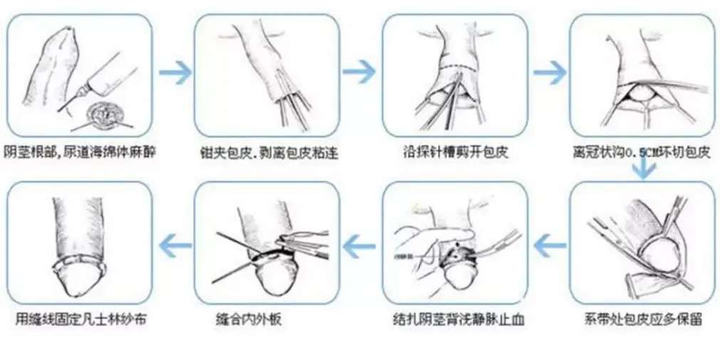 割包切割手术，真实案例与科学解读