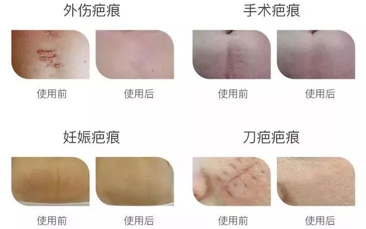 手术后疤痕的完美修复，科学方法与日常护理指南