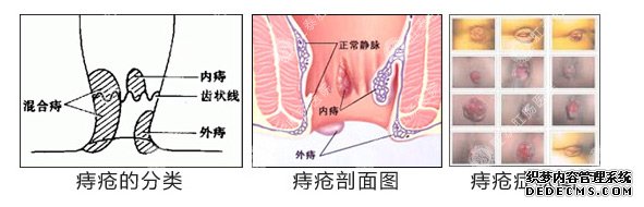 痔疮手术疤痕的消除方法与护理指南