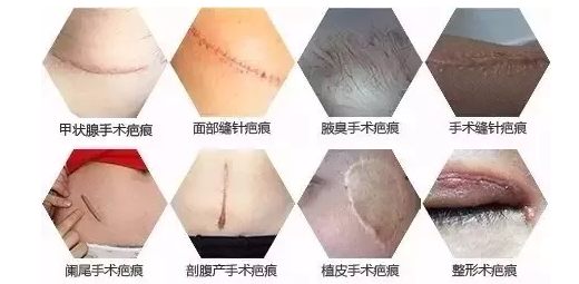 手术疤痕修复挂号指南，专业科室选择与注意事项