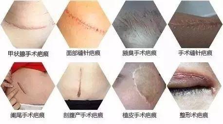 手术疤痕修复的现代医学奇迹，从过去到未来的对比图解