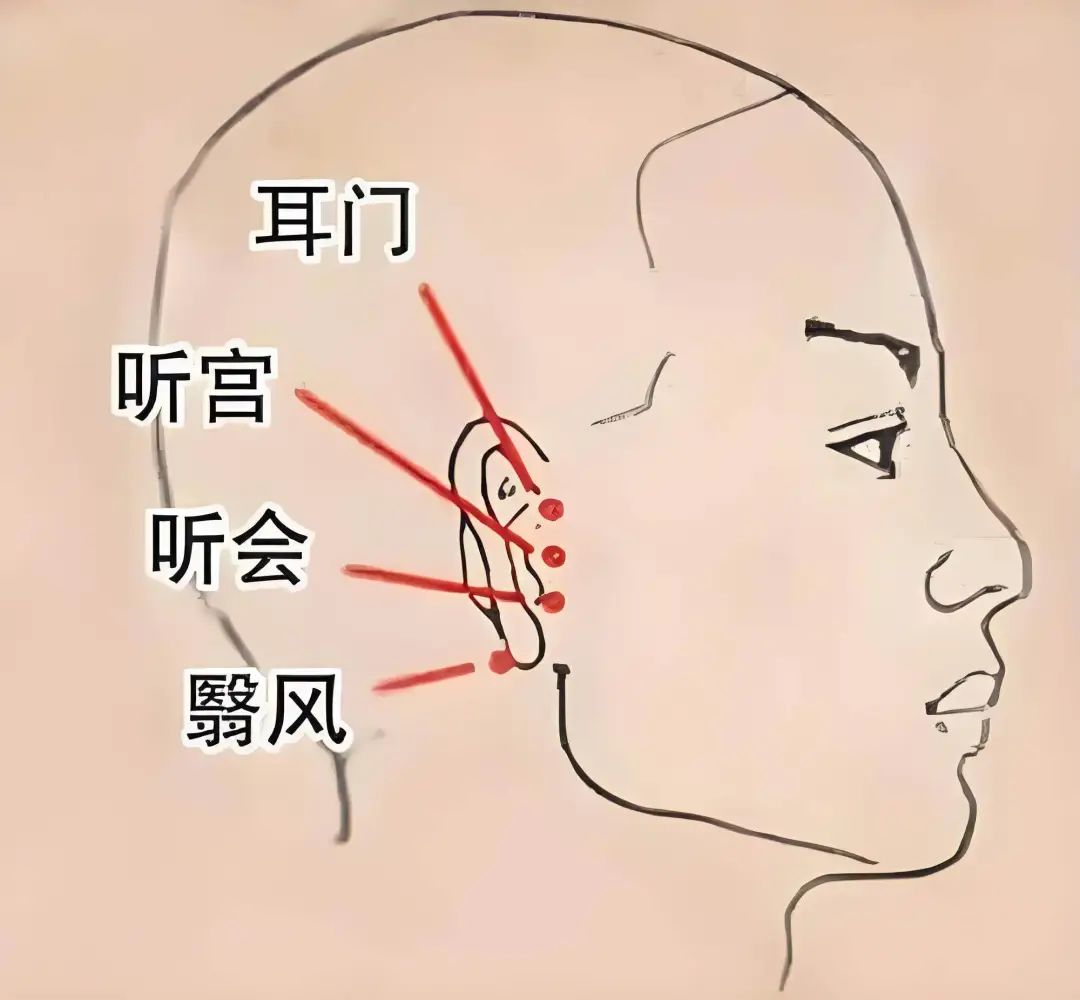 穴位疗法，揭秘治疗耳鸣的神奇穴位