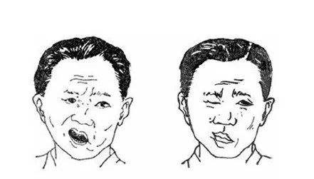 面瘫的中医治疗，解锁穴位疗法的奥秘