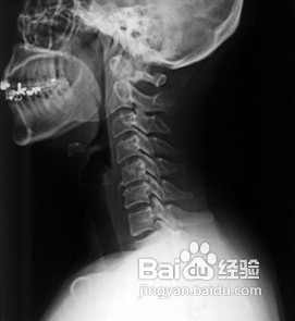 怎样治疗颈椎病最有效的方法