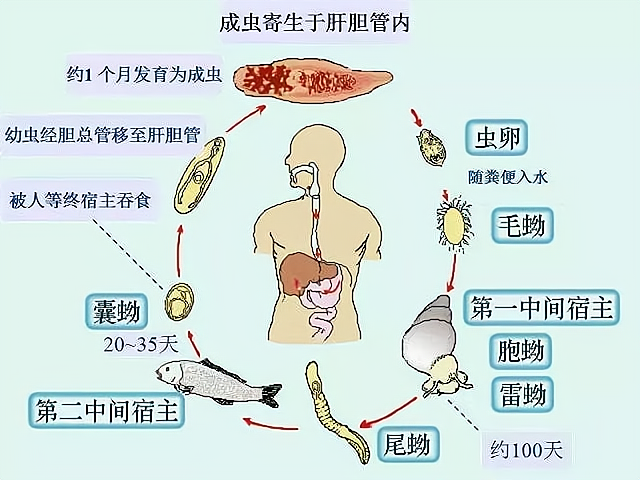 血吸虫肝病，不容忽视的疾病与治疗必要性