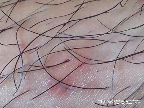阴虱子治疗，探索最佳药物选择