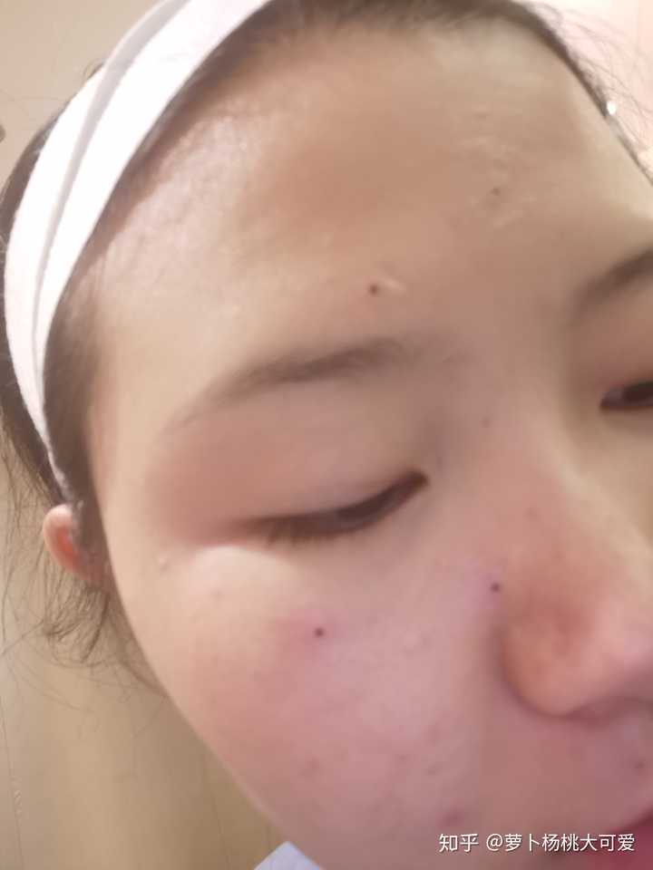 深圳医院激光点痣价格全解析，一颗痣的美丽代价