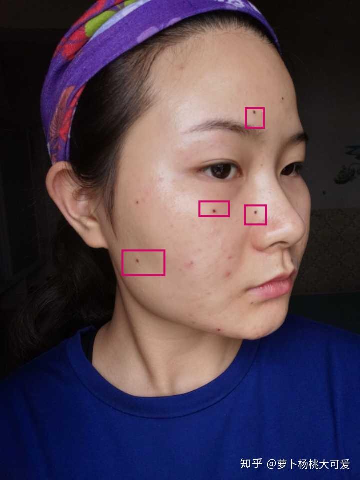医院点痣，女生突出痣的去除费用与考量