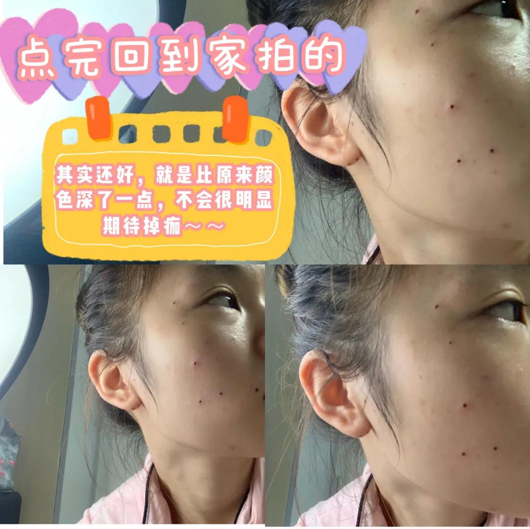 医院点痣价格指南，了解费用，安心变美