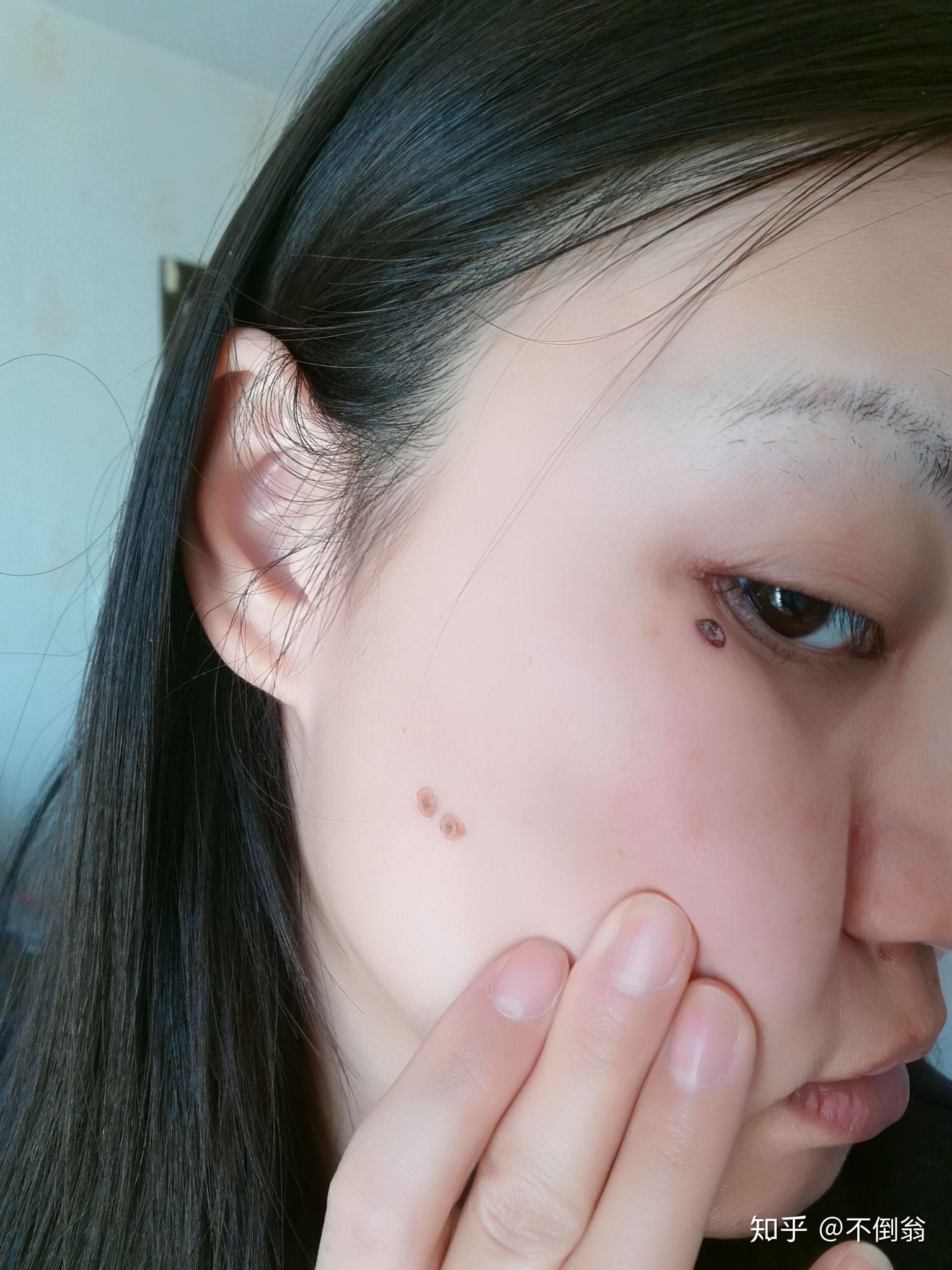 三甲医院点痣服务，专业与价格的完美平衡