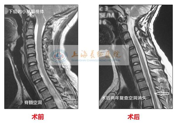 全国治疗脊髓空洞症最佳医院排名与解析